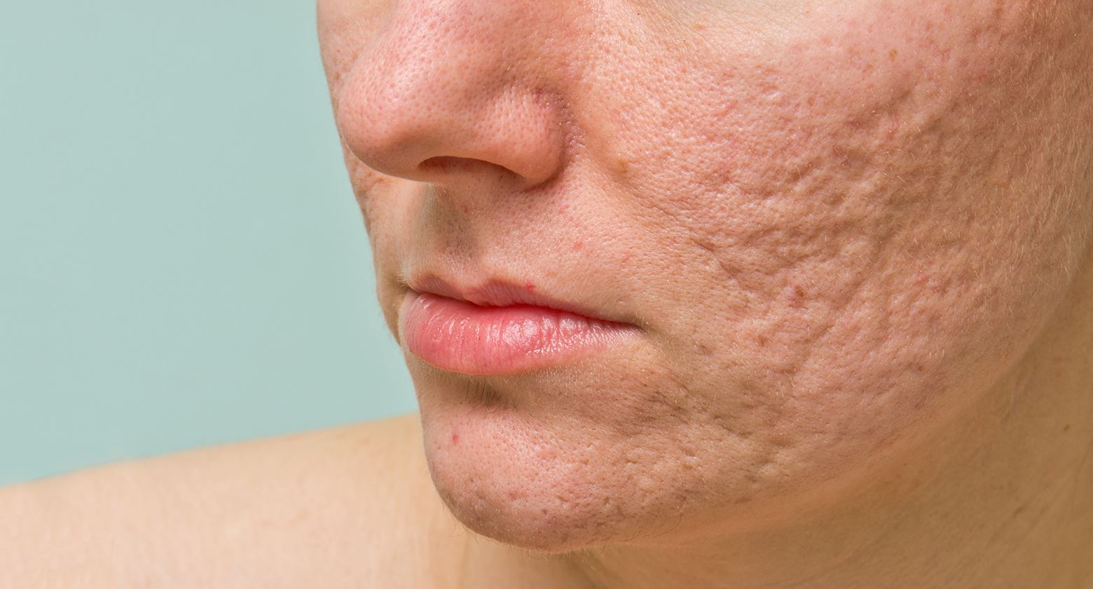 Láser cicatrices de acné y - Dermoquirurgica